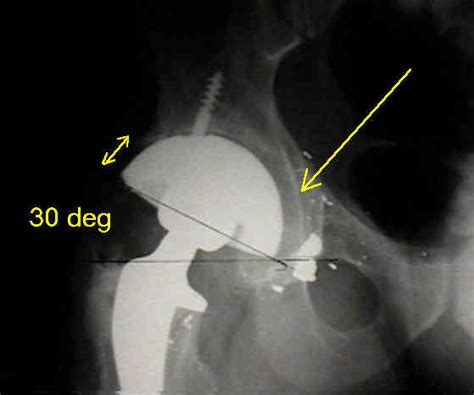 acetabular reaming technique|THR: Acetabular Reaming : Wheeless' Textbook of .